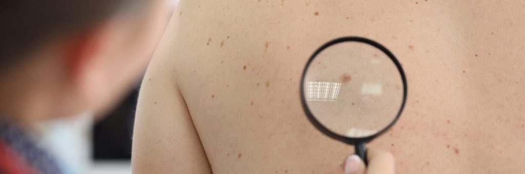 Huda nevarnost kožni rak, ki preži na vsakem koraku – Vredno ogleda